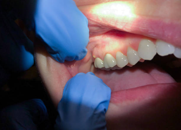 Best Broken Tooth Emergency  in Rancho Laveras, CA